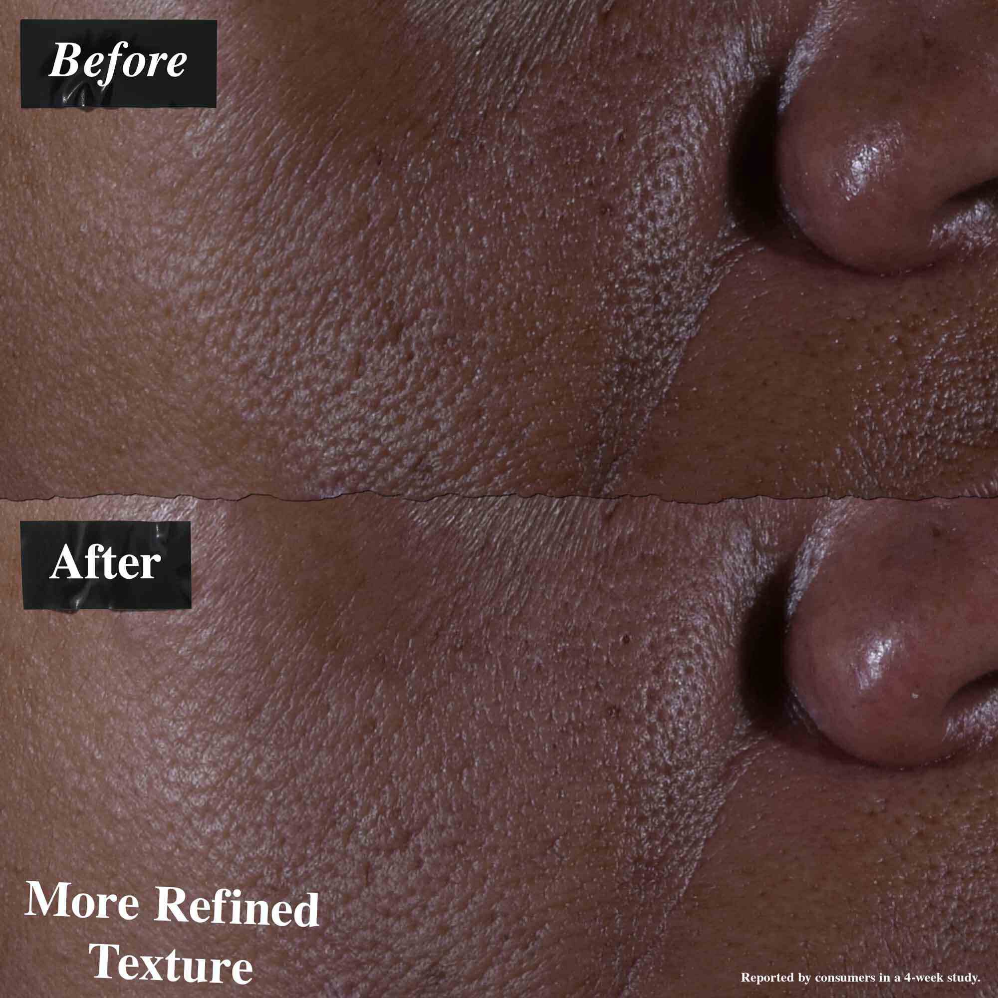 Un confronto prima e dopo che mostra la pelle trattata con Ultra Pure 9.8% Glycolic Acid Serum. L'immagine "prima" mostra una texture irregolare, mentre l'immagine "dopo" mostra una texture piu raffinata.