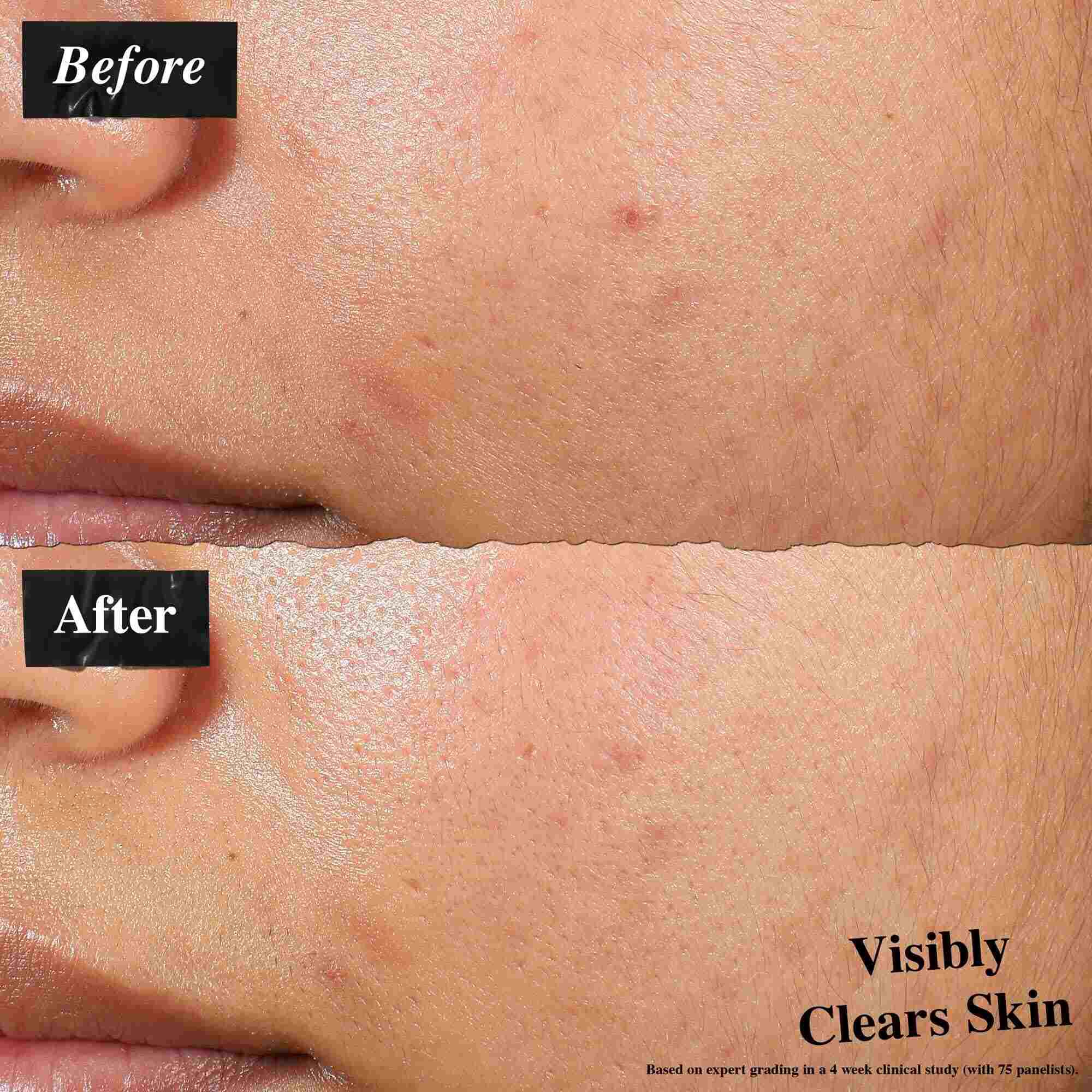 Un confronto prima e dopo che mostra la pelle trattata con Expertly Clear Blemish-Treating & Preventing Lotion. L'immagine "prima" mostra imperfezioni e texture irregolare, mentre l'immagine "dopo" mostra una pelle visibilmente piu pulita.
