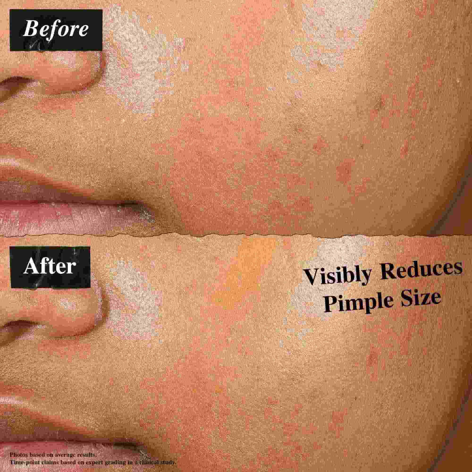 Un confronto prima e dopo che mostra la pelle trattata con Truly-Targeted Blemish-Clearing Solution. L'immagine "prima" mostra brufoli visibili, mentre l'immagine "dopo" mostra una dimensione ridotta dei brufoli.