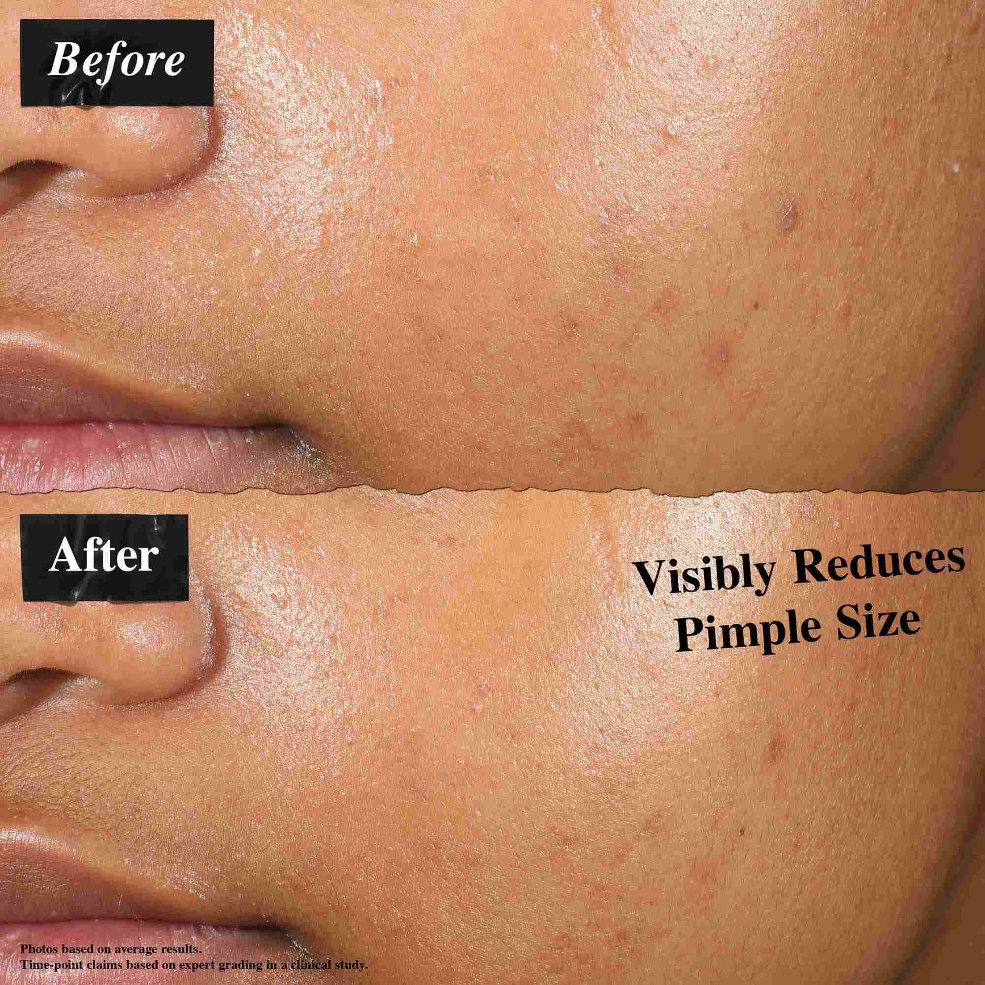 Un confronto prima e dopo che mostra la pelle trattata con Truly-Targeted Blemish-Clearing Solution. L'immagine "prima" mostra brufoli visibili, mentre l'immagine "dopo" mostra una dimensione ridotta dei brufoli.