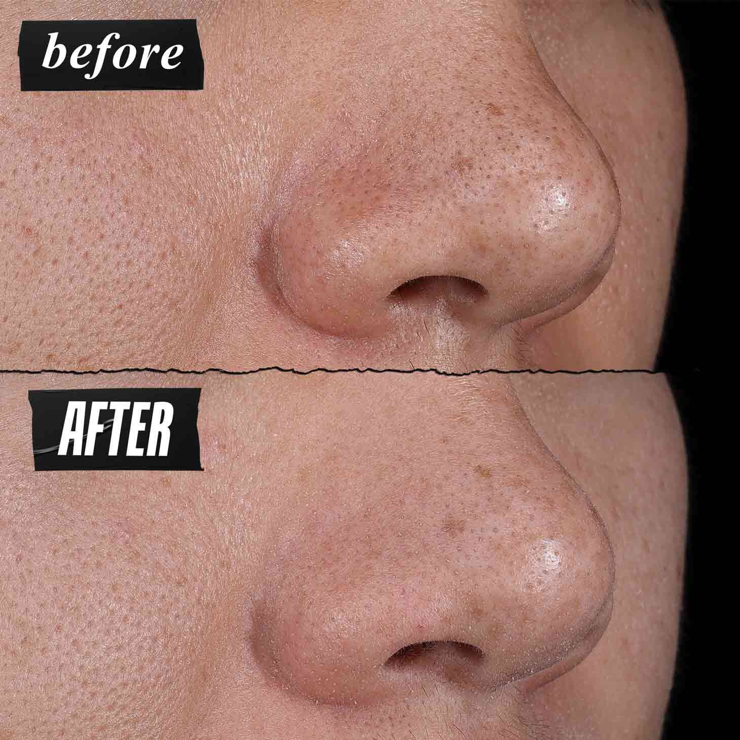 Foto prima e dopo: Kiehl's Rare Earth Deep Pore Cleansing Masque riduce visibilmente i pori