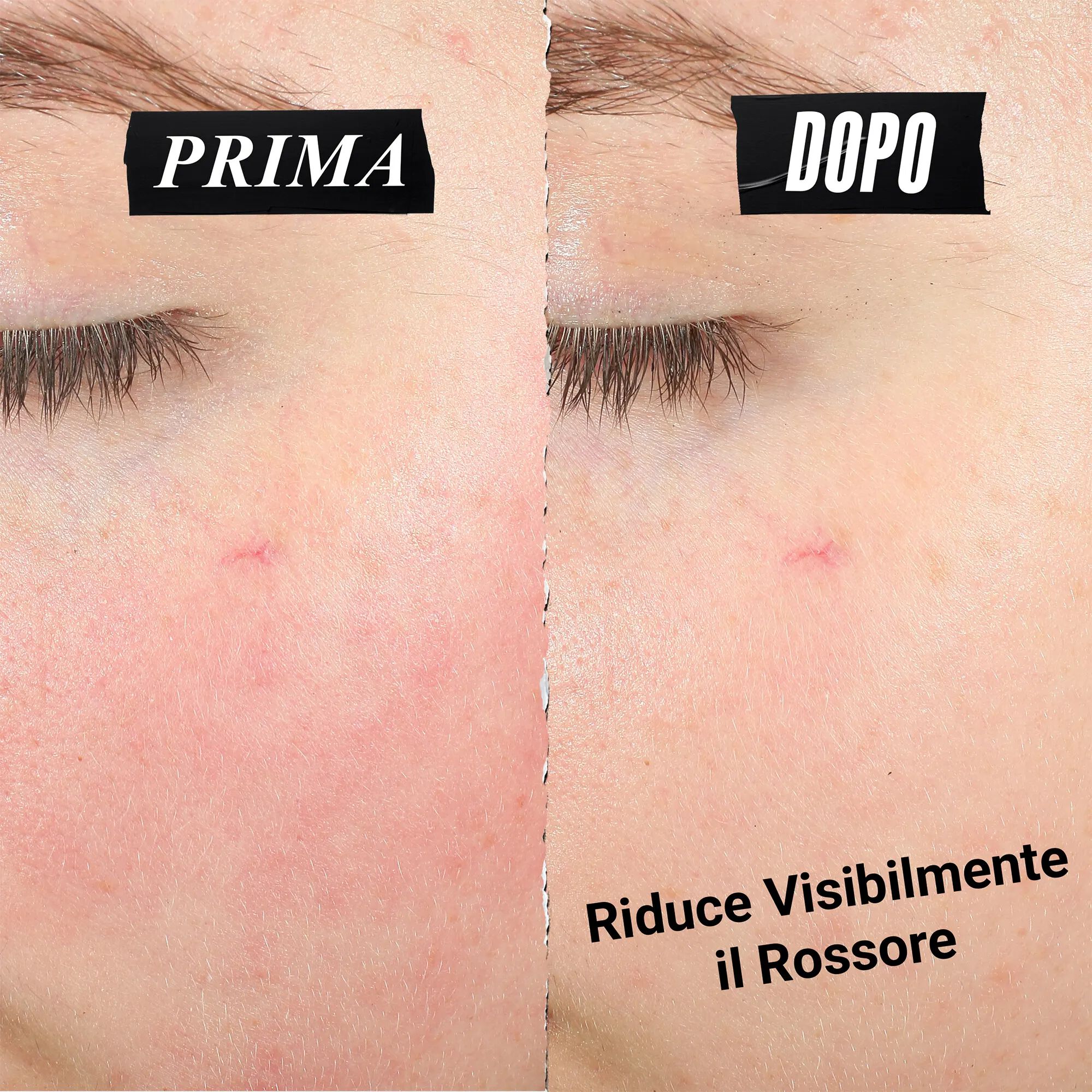 I confronti affiancati etichettati "prima" e "dopo" mostrano una riduzione del rossore sulla pelle. Il testo recita: "Riduce visibilmente il rossore."